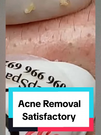 Acne Removal Satisfactory #fy #fyp #fypシ #acne #satisfyingvideo #limpezadecravos #satisfatorio #espinhas #pimple #squeezeyuk #satisfying #squeeze #blackhead