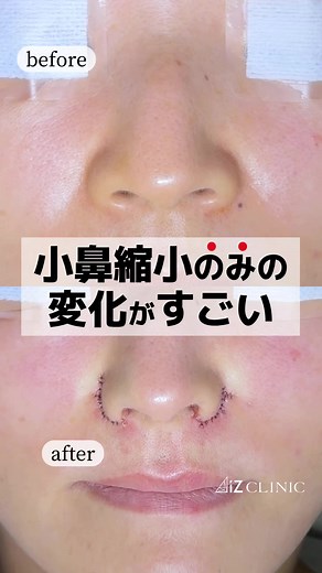 小鼻縮小の効果と自然な仕上がり