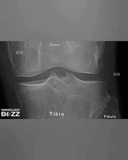 🦵Tibial Spiking on Knee AP X-ray 🦵