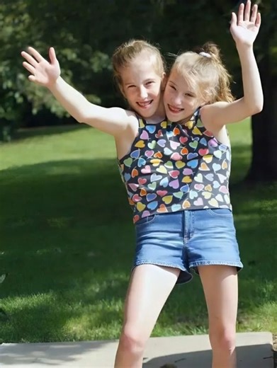 35K views · 111 reactions | These Siamese twin sisters have one pair...
