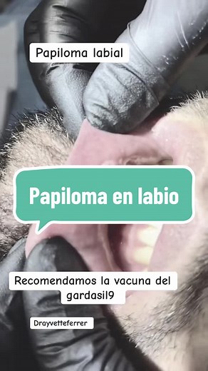 vph #papiloma #virusdelpapilomahumano #virus #lengua #papilomatosis #papilomahumano #papilomalingual #dentistas #dentistas #vacunavph #electrobisturi #dentistaentiktok #odontologiaen1minuto #odontologatiktok #paratii #foryoypage #fyp #foryou #drayvetteferrer #yvetteferrertok #cdmx #paratipage #fluorosistreatment #dentalfluorosis #odontologiaestetica #diseñodental #diseñodigital #dentalstudent #dentalschool #dentalassistant #dentalhygiene #dentalimplants #dentaloffice #dentaltok #dentalist #dient