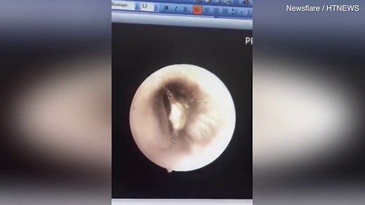 Stomach-churning moment cockroach jumps out of woman's ear