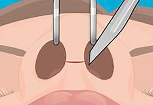 Operate Now: Nose Surgery