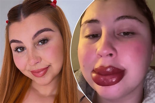 Woman has allergic reaction to lipstick tattoo