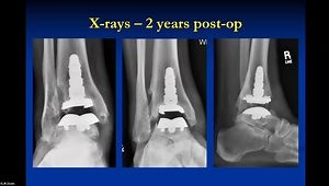 Underlying Foot Deformity Correction in Total Ankle Replacement: All at Once or Staged