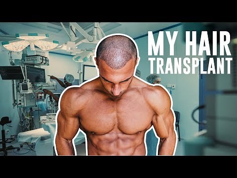 My Hair Loss Journey & FUE Transplant In London