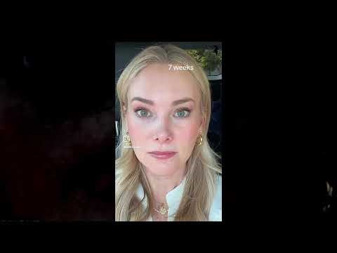 7 Weeks Post-Op: SMAS Endoscopic Mid Face Lift, Brow Lift & Corrugator Resection