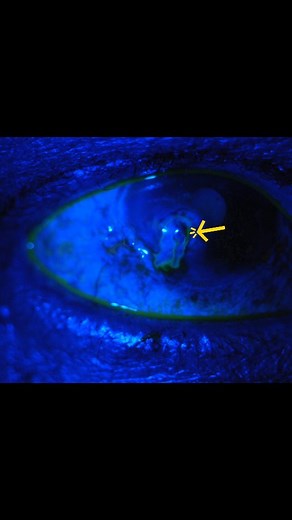 Dr Arnav Saroya on Instagram: "The Seidel test assesses for the presence of aqueous humor leakage from the anterior chamber. This leakage is from a defect in the cornea or sclera from multiple causes, including trauma, post-surgical leak, and corneal perforation. Seidel test is positive when the fluorescein dilutes in the aqueous humor and causes it to fluoresce bright green and stream down the eye with gravity. The streaming is sometimes described as a waterfall by some with more brisk leaks. T