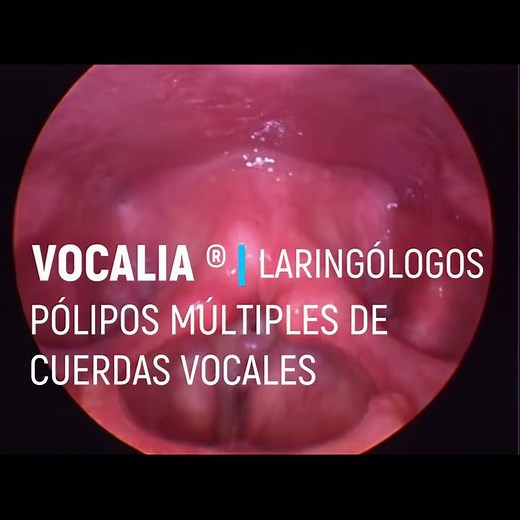 PÓLIPOS DE CUERDAS VOCALES “GEMELOS” - TWIN POLYPS, PÓLIPOS MÚLTIPLES DE CUERDAS VOCALES⁣