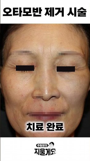 난치성 색소질환 오타모반! 완치 가능할까?