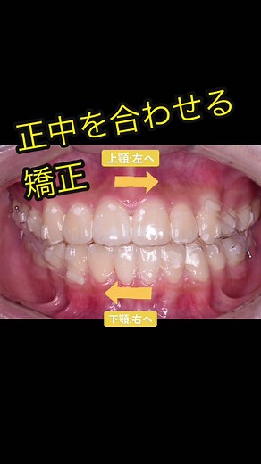 正中がずれているときの矯正治療方法と注意点