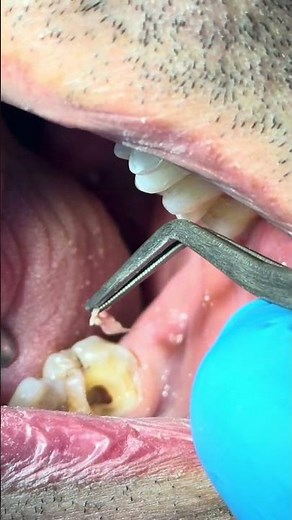 Dental Pulp Removal | Satisfying Root Canal