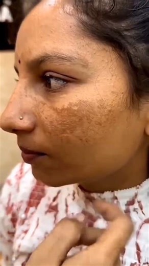 How To Remove Pigmentation/Dark Spots At Home ? DIY Pack For Reduce Pigmentation 🌿 #skincare #diy