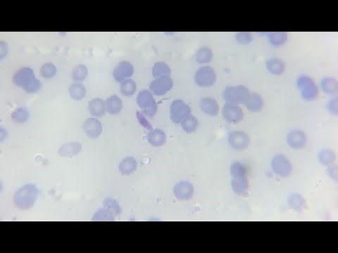 Malaria parasite plasmodium falciperum gametocyte in thick and thin blood smear in microscopic slide