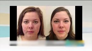 The Doctor Explains Acne Causes, Effects, and Treatments