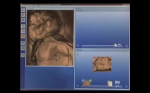 CEREC AC Onlay Restoration 瓷嵌体制作