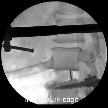 How to Perform a Lumbar Fusion….In Under 15 seconds