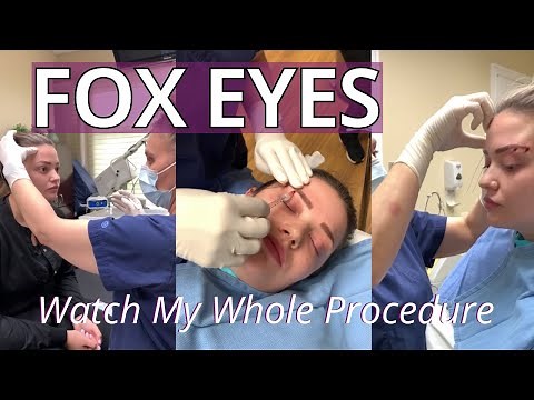 Watch My Foxy Eyes Thread Lift [ See the Whole Thing Start to Finish ]