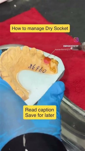Management of dry socket #viral #dental #doctor #smiledesigndental #explore #shortvideo #shorts