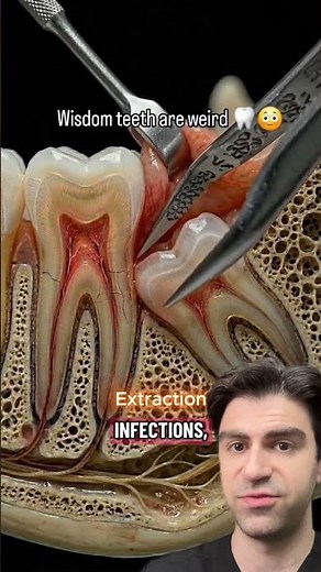 Do You HAVE To Remove Your Wisdomteeth?