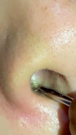 Epic Blackheads. Super pops. Zit Pops. Blackheads Removal. Enjoy Popaholics!💋 #505