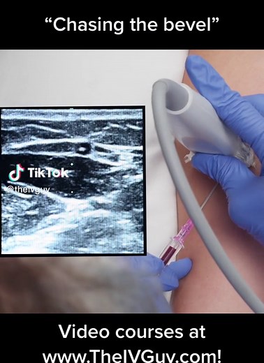 Here we’re showing how to locate and advance your needle within the lumen of a vein using ultrasound. The ultrasound IV insertion video course is 30% off and comes with CEUs (along with all my other courses)! Click the link in my profile or head to www.TheIVGuy.com/courses to learn more #nurse #rn #rnlife #nurselife #nurseproblems #nurses #registerednurse #nursingstudents #nursingstudent #studentnursesoftiktok