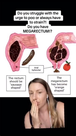 Pelvic health wellness store on Instagram: "Chronic constipation isn’t always about “not eating enough fibre” — although that can certainly play a role. In many cases, it’s a combination of several factors, and understanding the root cause is key to effective, long-term relief. 👉 Dietary factors like low fibre intake and dehydration can slow the movement of stool through the bowel. Fibre adds bulk, while water keeps it soft and easier to pass. Without enough of either, the bowel can become slug