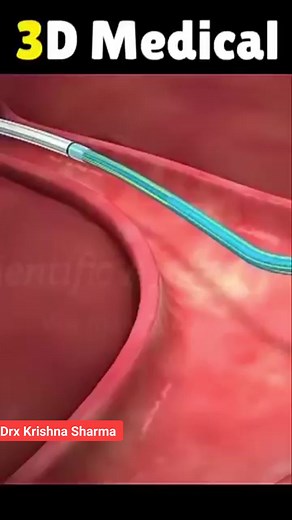 6.3K views · 21 reactions | Piles grade and surgery 3D Animation #reels #trending #viral #instagram #viralreels #reelsvideo #shorts #short #piles #drkrishnasharma | Drx Krishna Sharma | Facebook