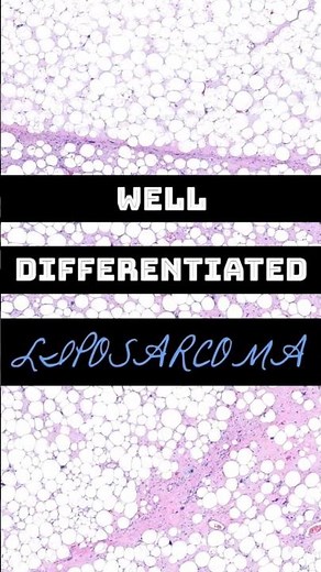 Well-Differentiated Liposarcoma / Atypical Lipomatous Tumor (WDL/ALT) | 3 Things To Know | #BSTPATH