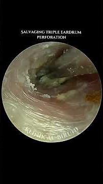 Salvaging Triple Eardrum Perforation