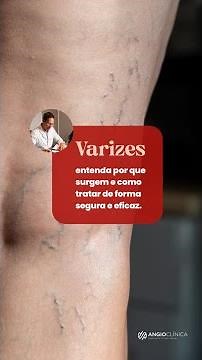 Você sabe o que são varizes e como tratá-las?