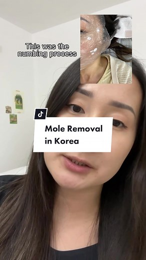 Mole Removal Procedures in Korea Explained