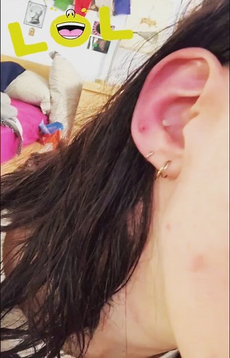 Best Pimple Popping Videos | Ear pimple popping. So satisfying! #blackheads #satisfying #relaxing #satisfyingvideo #blackheadremoval #blackheadremoval #popping... | Instagram