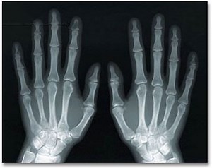 RSIs on the rise, says report, but prevention is simple