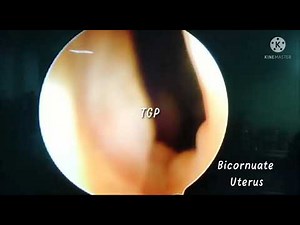 Complete Bicornuate Uterus on Hysteroscopy