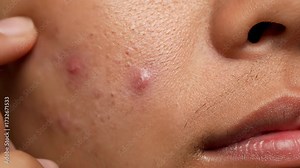 Close up view of an individual popping a pimple on their cheek. Illustrating skin issues, hormonal changes, and the field of dermatology Stock Video