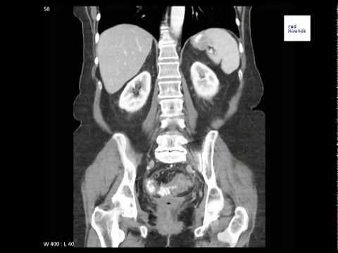 Diverticulitis on CT Scan