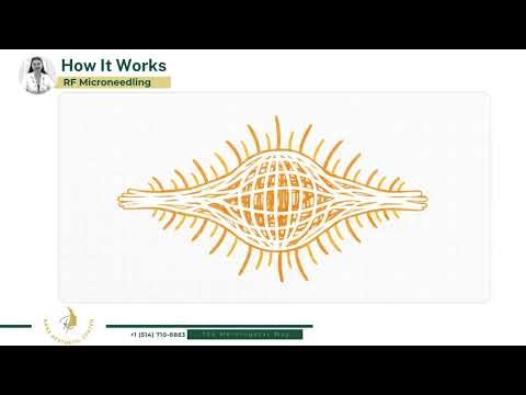 RF Microneedling
