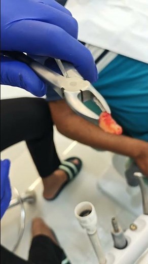 painless tooth extraction