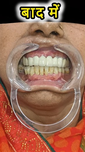 Upper Full Fixed Tooth Capping 💪🔥#dentist #drshivamverma #tooth #capping #shorts #doctor #dentistry