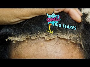 Fast And Easy Scratching Dandruff Big Flakes Front View #468