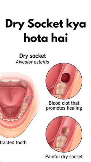 Dry Socket Kya Hota Hai? | Tooth Extraction Complication