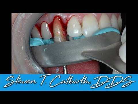 Anterior Implant & Crown - Tooth Extraction & Immediate Placement of Implant