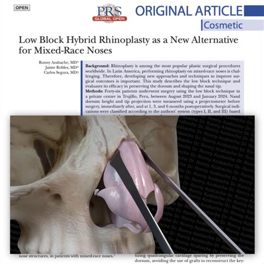 PRS Global Open on Instagram: "Is the low block technique effective in maintaining the preservation and structuring of the nasal tip and dorsum? 👃⁠ ⁠ Find out by reading this #PRSGlobalOpen paper, "Low Block Hybrid Rhinoplasty as a New Alternative for Mixed-Race Noses," by Azabache, Robles, and Segura: (Link in our bio)⁠ ⁠ @drronnyazabachediaz @dr.jaimeroblesmoran @carlossegurafranco @plasticsurgeryASPS #rhinoplasty #nosesurgery #hybridrhinoplasty #dorsalpreservation #mixedrace #latinnose #cosm