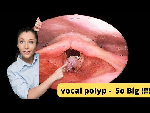 Vocal polyp | in Hindi | Micro laryngeal Surgery | Voice therapy