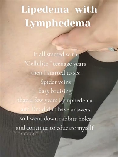 Lipedema vs Lymphedema: Signs, Stages, and What I Wish I Knew