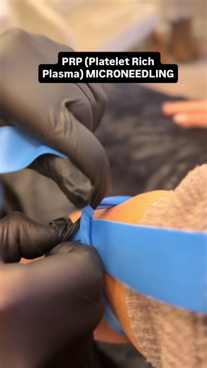 PRP Treatment for Youthful Skin and Hair Growth