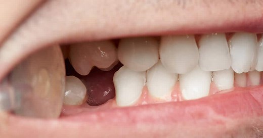 Hypodontia Treatment: Causes of Congenitally Missing Teeth - Dentaly.org
