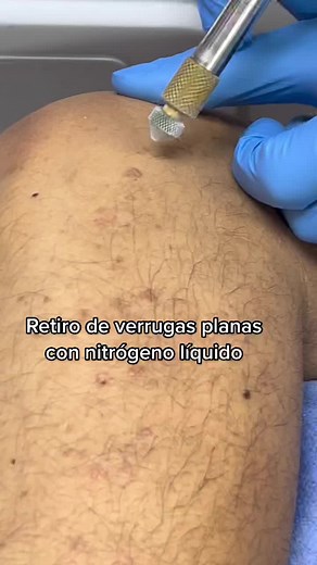 Cómo eliminar verrugas planas con nitrógeno líquido