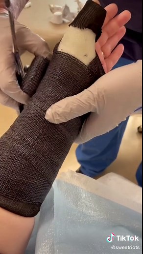 Replacing the Old Cast with the New: Broken Thumb Injury